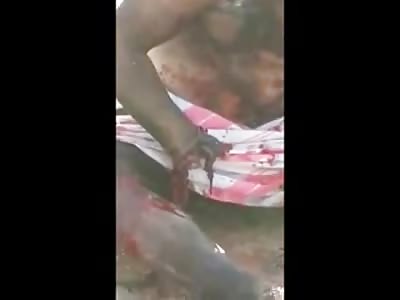 Man Hit by IED sits in Shock with Missing Limbs 