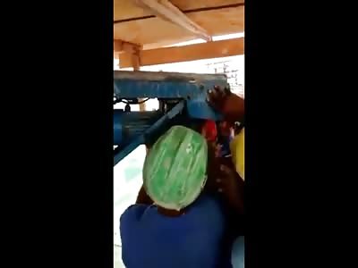 Dont Look At It..Man with Mangled Arm in a Nightmare Accident 