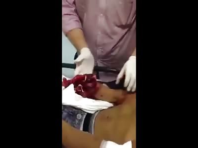 Kids Hand Ripped Apart From Carelessly Handling a Firework