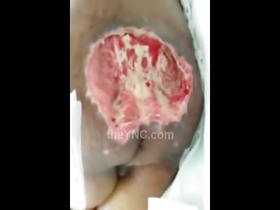 Ever Heard of Bed Sores? WTMF!!