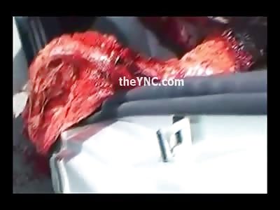 Woman got her Legs Caught Up in Earth Moving Equipment...Not Good 