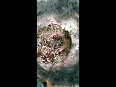 Disgusting Big Hole in her Head Full of Maggots