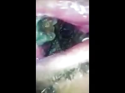Disgusting Mouth Infested With Maggots