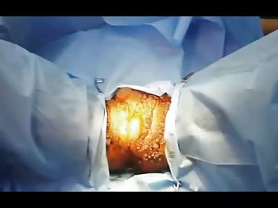 Genital Warts....Possibly the Most Disgusting Video you Will Ever See 