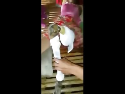 Bizarre Video of a Young Girl with a Dead Leg that Should have Been Amputated a Long Time Ago 