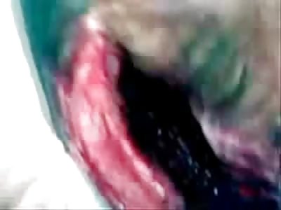 Morocco Man Tries to Talk to Doctors With Half His Face Missing.....He Makes a Miraculous Recovery.....DAMN!!!!