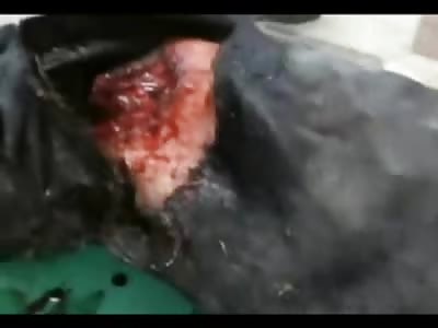 Man Fully Awake with Half His Face Missing ... Tries Talking