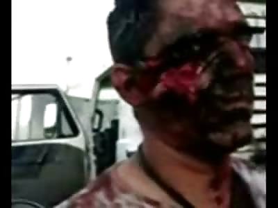 Mans Eye Hacked out with a Machete walks Around in the Street