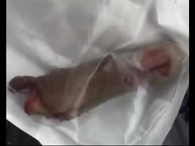 Worker has a Few Less Fingers to Work with after this Accident