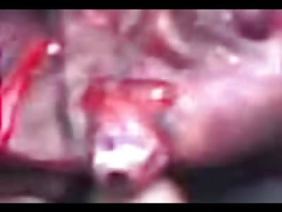 Dangling Eyeball and a Crushed Head after Deadly Accident