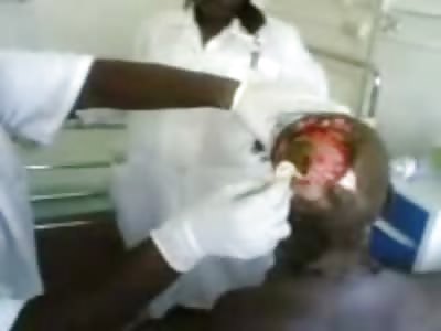 Bizarre Cell Phone Video if Man Missing his Entire Scalp Exposing his Skull