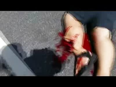 Fat Woman Sits on the Street in Shock with her Mutilated Leg