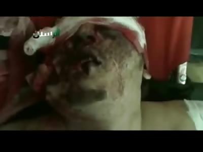 BAD DAY: Man Still Alive Has Half his Face Blown off, is Blinded and Can Barley Move his Mouth