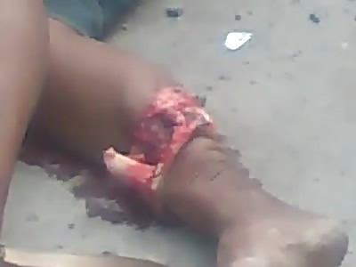 Leg Snapped in Half Bone Fully Exposed......OUCH!!