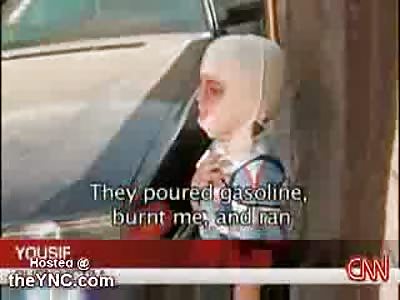 Boy, 5 doused in gasoline and set on fire