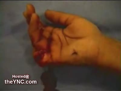 Finger vs. a Table Saw