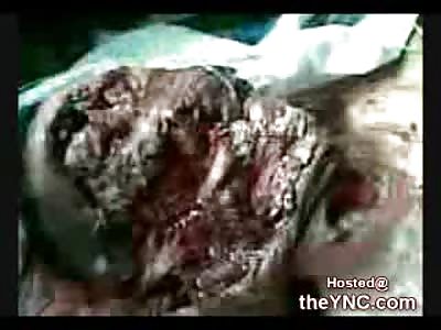 Faceless Man still alive after a Motorcycle Accident (Very Graphic 18+)