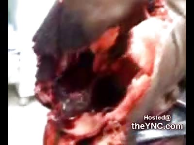 Mans Head Blown WIDE Open from an Assault Rifle (18 + Only)