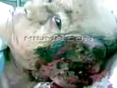 Woman with a Horrific Injury and a Dangling Ear