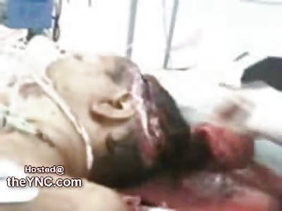 Young Boy with a Wide Open Head holds onto Life in a Hospital Bed