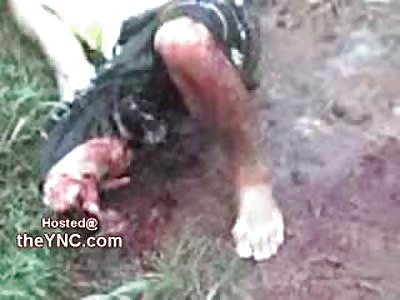 Pain Captured on Camera: Man Loses his Lower Leg