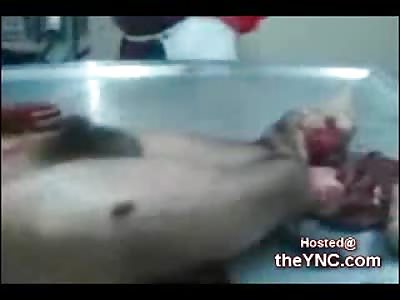 Suicide Jumper Snapped Limbs and Crushed Head