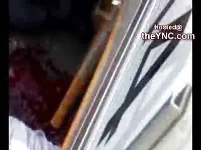 Woman Run over by Bus has Mangled Leg Pushed through her Tight Jeans