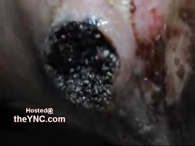 Casually Removing Worms from Festering Infected Foot