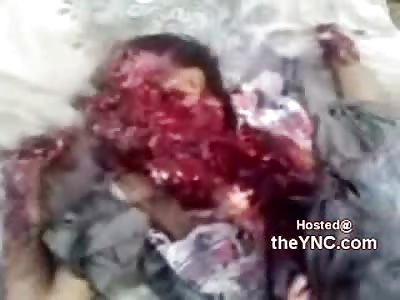 Tragic: Young Boy Unrecognizable after After Stepping on a Land-mind  in Yemen while Playing Soccer