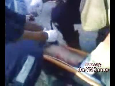 Nasty: Man in Agony With his Leg Bone Popped out of the Skin