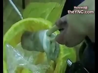 Man with Infected Feet to the Bone has Amputation by Wire into Garbage Can