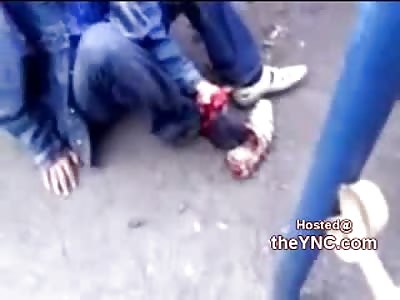 DISGUSTING: Man's Foot Flopping Around and Kept on by Tendons and Skin Only (Run Over by Train)