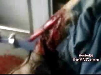 The Worlds Worst Ambulance Crew Ignores Man with Tibia Bone throuth the Skin  