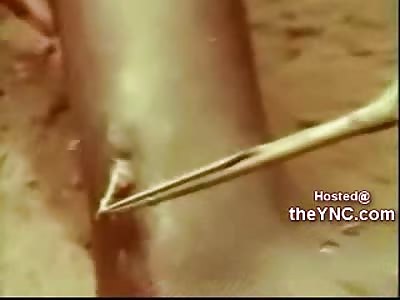 Africans Infected with Parisitic Worms