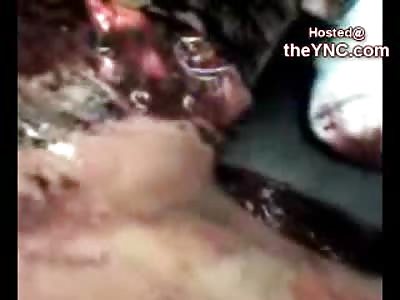 Doctors try to Help Man Partially Decapitated