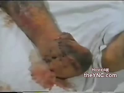 Crazy Sick ass Amputation of Gang Green Limbs on Soldiers During War Time