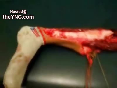 Boy with Severed Leg Wide Awake and some Dish Soap