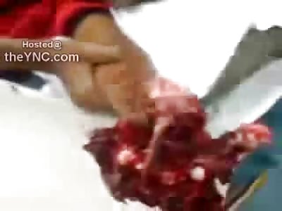 OH MY Disgusting FIRE Accident Disintegrates Boy's Hand Off 