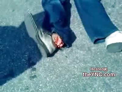 When an Accident Severs your Foot....it Really Sucks!!