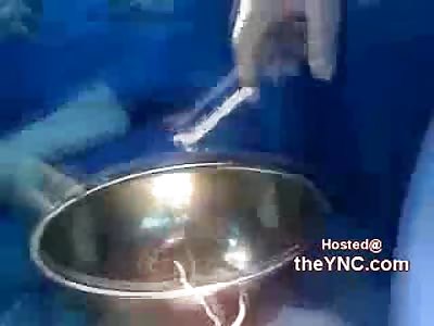 Disgusting: Worms Taken out of 3 Year Olds Intestine 