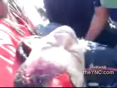 Man Scalped to the Skull now Has a Very Unsafe Ride to the Hospital Coming as Well