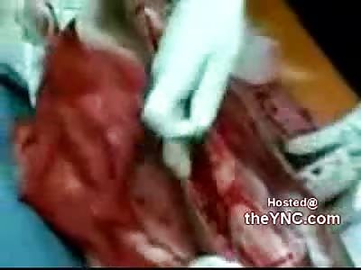 Now Thats One Fucked up Leg