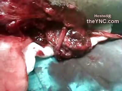 UGH....Man has Giant Artery Hanging out of Leg still trying to Pump Blood