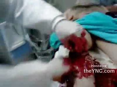 UGH...Man brought into ER with Gruesome Leg Partially Amputated by Car