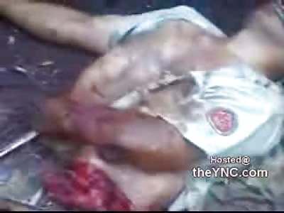 QUARTERED by Tractor Trailer...Legs End Up on the Tractor