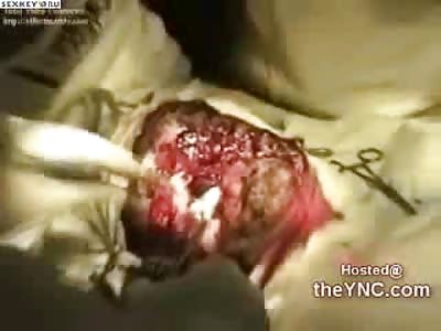FLOP FACE: Amazing Video of Man with Face Ripped Off and Doctors Working to Save It