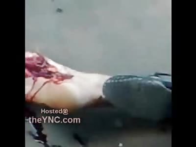 Man in a World of Pain with Disfigured Foot after Accident