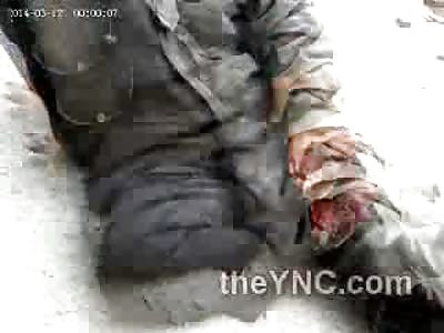 Terrible Leg Injury Shows Muscle Movement ...Yuck!