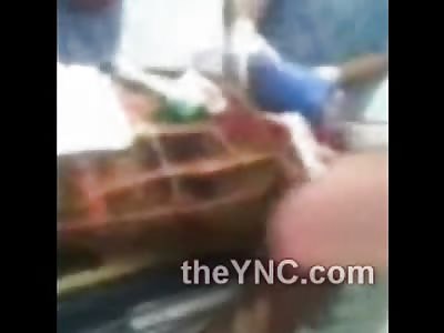 Man Horrifically Burned all over is Still Alive Struggling to Breathe