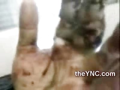 Kid shows Off his Hasnd Blown Apart by Firework Explosion